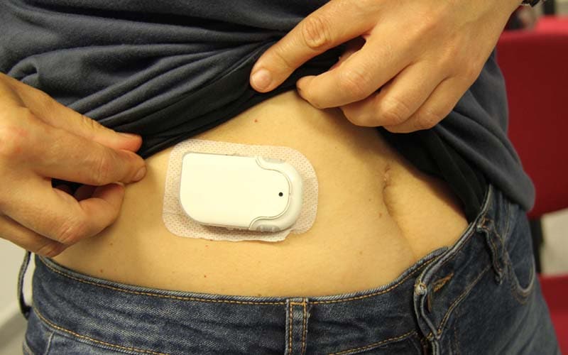 Bomba de insulina ya sobre la piel del paciente (foto: Hospital Universitario del Sureste)